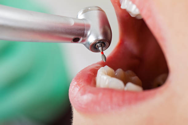 Best Emergency Tooth Extraction in Nroe City, MO